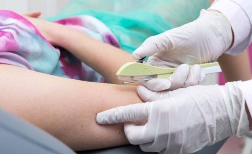 Implante contraceptivo hormonal será obrigatório em planos de saúde