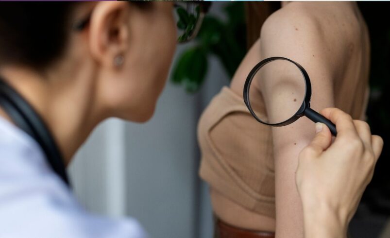 reforça ações para prevenir o câncer de pele e alerta sobre o uso correto do protetor solar