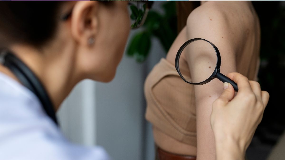 Verão no estado do RJ reforça alerta contra o câncer de pele